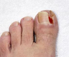 ingrown toenail