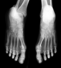 What Is a Stress Fracture?