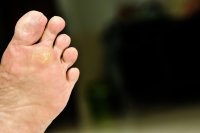 Why Your Heel Pain May Be Plantar Fasciitis