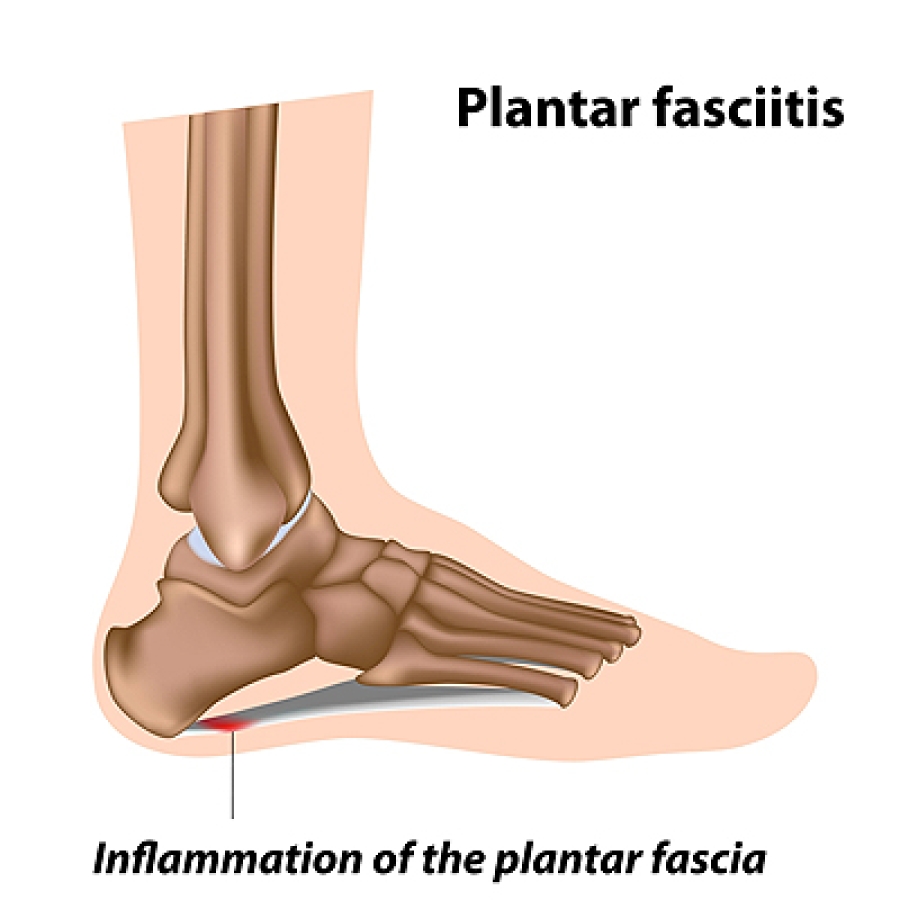 Should I See a Physio or a Chiropodist for Plantar Fasciitis? -  Physiomobility