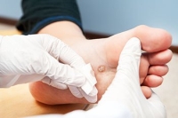 How and Where Plantar Warts Occur