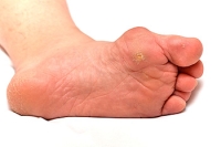 Corns and Calluses on the Feet