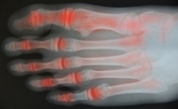 Rheumatoid Arthritis May Affect Different Parts of the Foot