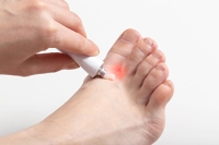 Causes and Symptoms of Athlete's Foot